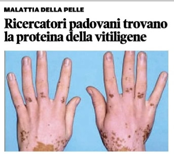 vitiligine articolo Mattino di Padova